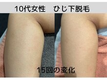 ビモア(Bmore)/★ビフォーアフター★