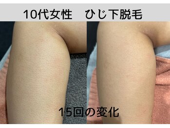 ビモア(Bmore)/★ビフォーアフター★