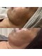 サロンノワ(salon noix)の写真/【島根・松江】今から始めるシミ・しわ予防！長年悩んできたシミのお悩みも、当サロンにお任せください☆