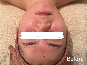 ダイヤモンド リーエンダ(Diamond leende)/クレイハーブピーリング