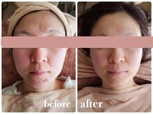 スペチアーレ 夙川/肌質改善