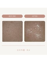 ソニョ(Sonyo)/エステbefore after