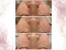 ウェリナポノビューティサロン(welina pono beauty salon)/《小顔/毛穴/脱毛》