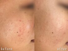 エヌエースキン 武蔵小杉店(Naskin)/ニキビケアにはハーブピーリング