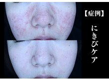 The水光美肌専科/高濃度イオン導入