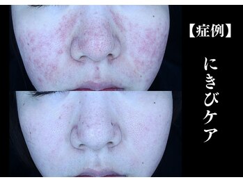 The水光美肌専科/高濃度イオン導入