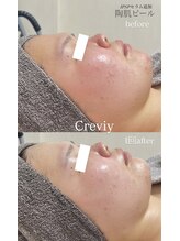 クレヴィー(Creviy)/陶肌ピール1回