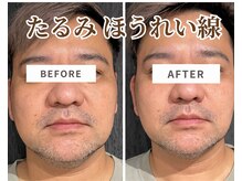 フェイスプラスリフ(FACE+RiF)/顔のリフトアップ/目の開き改善