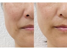 ヒト幹細胞50％＋エクソソーム×エステダーマでシワたるみケア