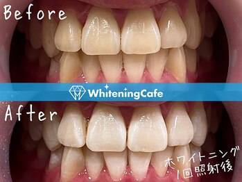 ホワイトニングカフェ 姫路駅前店(WhiteningCafe)/ホワイトニング1回照射