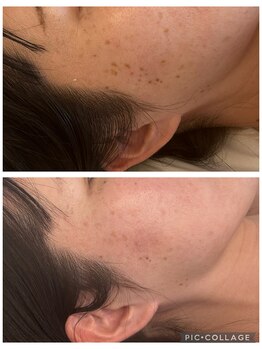 ハートエルボー(Heart elbow)/サロン施術のみ3ヶ月のお客様