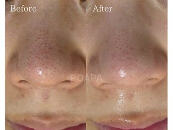 ポアラ(POARA)/毛穴/ワックス脱毛