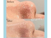 フォルチェ ゆめタウン東広島店(Folche)/毛穴引き締めフェイシャル