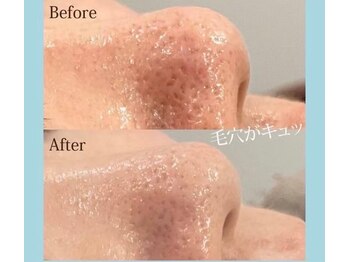 フォルチェ ゆめタウン東広島店(Folche)/毛穴引き締めフェイシャル