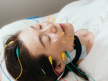 ピーチ鍼灸整体治療院(Peach鍼灸整体治療院)の写真/《大人気★》本格美容鍼でリフトアップ・ほうれい線・たるみにお悩みの方に◎