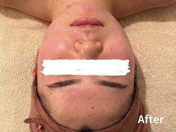 ダイヤモンド リーエンダ(Diamond leende)/クレイハーブピーリング