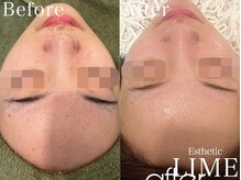 ライム 錦糸町(LIME)/ ハーフピーリング｜毛穴洗浄