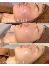 プレジール(plasir)/ニキビケアお任せください♪