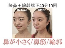 ラプリ 梅田店(Raplit)/隆鼻＋輪郭矯正40分10回