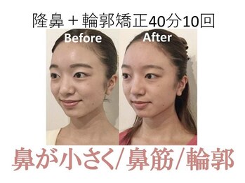 ラプリ 梅田店(Raplit)/隆鼻＋輪郭矯正40分10回