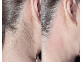 アンクロエ 心斎橋店(an chlo'e)/うなじワックス脱毛