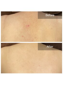 ビビ(VIVI)/背中のケアに