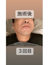 ゴッド(GOD)/髭脱毛