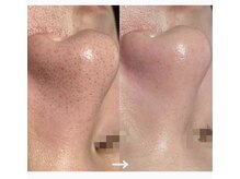 シアンビビ(Cyaan bibi)/韓国式３D毛穴洗浄