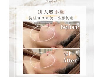 ラフィール/小顔になりたい：２回