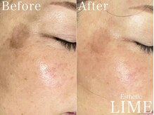 ライム 錦糸町(LIME)/ ハーフピーリング｜シミケア