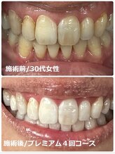 ホワイトニング ビューティー 南魚沼店(whitening beauty)/ホワイトニング☆症例