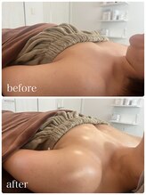 リノ 行橋(lino)/◇バストアップ症例◇40代