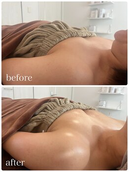 リノ 行橋(lino)/◇バストアップ症例◇40代