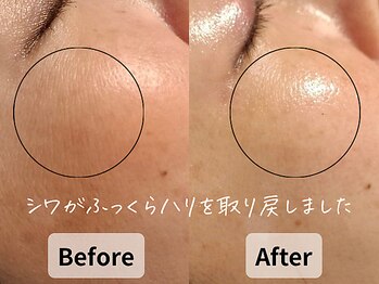 バタフライ 平塚店(Butterfly)/目元から頬にかけての小ジワ改善