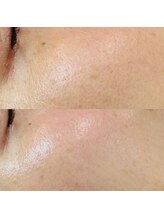 ルーク(Luke)/毛穴ケア