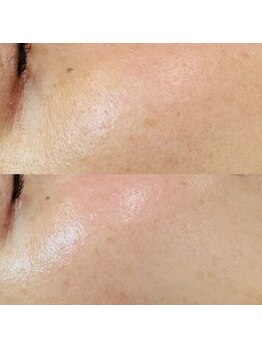 ルーク(Luke)/毛穴ケア