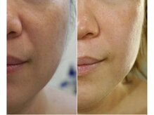 ミル(milu)/ほうれいせんも一回でキュッと！