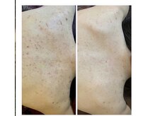 エミルカ 札幌駅北口店(EMILUCA)/お背中ビフォーアフター