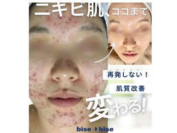 ビズビズ 梅田店(bisebise)の写真/【医療機関提携】皮膚科でもダメだった何をしてもくり返すニキビケアに終止符！消えない赤み改善￥3800～