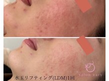 サロンヴェアリー 広尾(salon vary)/水玉リフティングLDM｜1回施術
