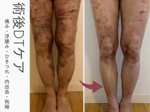 ■術後DTケア■★術後施術実績多数★《術後ラフォスで辛いダウンタイム軽減×綺麗な仕上がりに♪