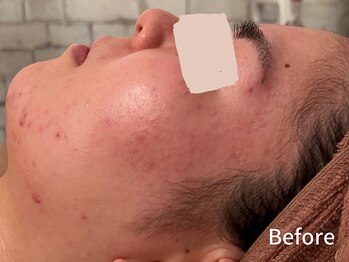 ダイヤモンド リーエンダ(Diamond leende)/クレイハーブピーリング