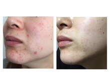 ナチュライズ(NatuRise)/ニキビケア