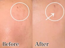 いやしの家さくら/シミケアビフォーアフター