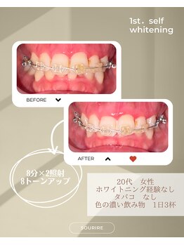 スリール(sourire)/ビフォーアフター