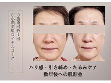 ベラ 東京院(Bella)/ほうれい線、頬コケたるみサーマ