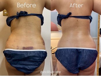 インディバケアプラチナム 恵比寿店/腰/術/後ケア/インディバ