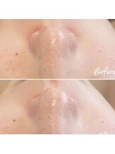 ラルミエール 緑店はなれ(la lumiere)/毛穴コース