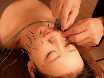 カラダリセット 上本町の写真/【小顔ケア】美容鍼×小顔矯正でWアプローチ！ほうれい線・たるみ・むくみケアでシャープな輪郭へ◎