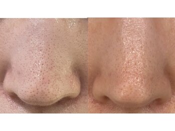 ココリール/いちご鼻